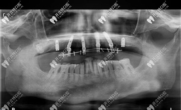 通過數(shù)字化動態(tài)導航種植恢復半口牙 通過數(shù)字化動態(tài)導航種植恢復半口牙