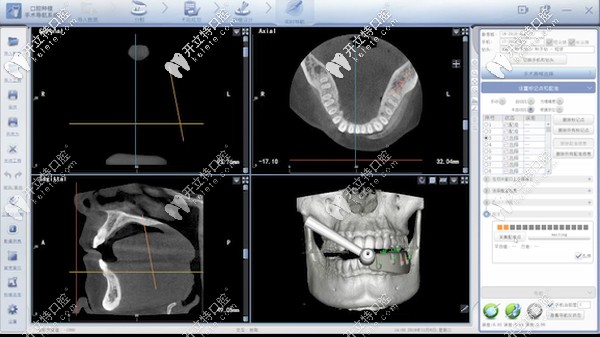 數(shù)字化動態(tài)導航種植技術