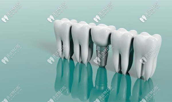 種植4顆植體和6顆植體的費用一樣嗎