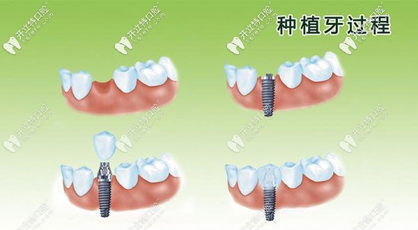 做一顆種植牙的過程圖