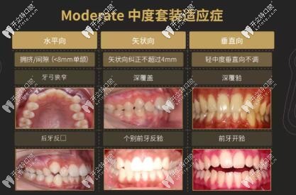 隱適美m(xù)oderate的適應癥