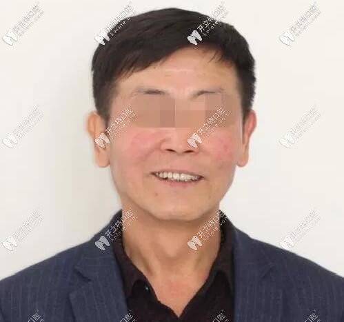 上頜竇外提升喜提ALL-ON-6半口馬龍橋種植牙,10年活動義齒拜拜