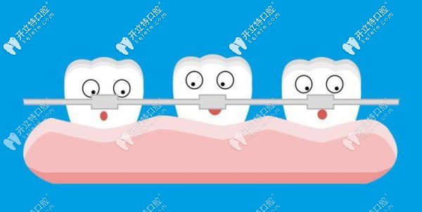 追問(wèn):蘭州牙王國(guó)口腔做牙齒矯正多少錢(qián)(含舌側(cè)正畸價(jià)格)