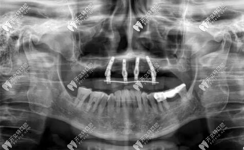 西安美奧口腔半口種植牙案例