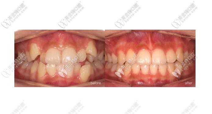 牙齒矯正案例圖