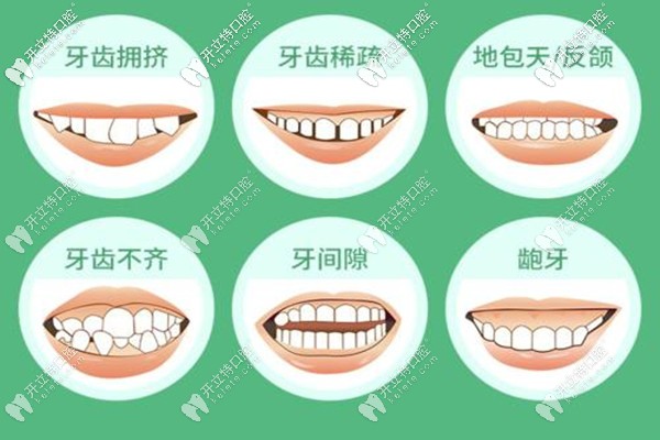 蘭州牙王國口腔金屬矯正，舌側(cè)矯正多少錢