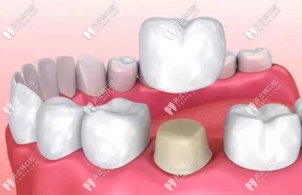 全瓷牙國(guó)產(chǎn)和進(jìn)口的區(qū)別