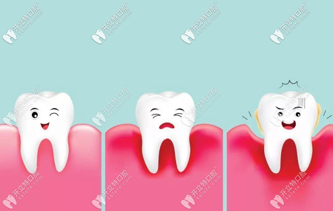 牙周炎引起的牙齒松動(dòng)