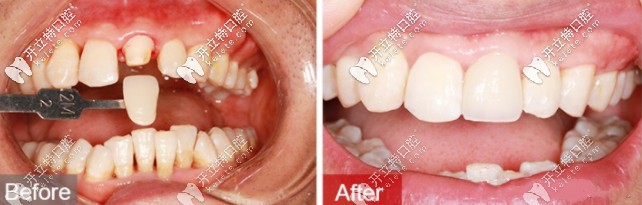 德國(guó)進(jìn)口全瓷牙套價(jià)格表get，威蘭德和國(guó)產(chǎn)愛(ài)爾創(chuàng)哪個(gè)好