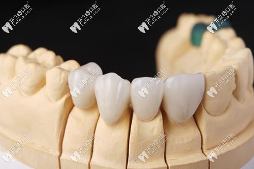 回復(fù)我：美國3m全瓷牙和澤康的區(qū)別？lava全瓷牙多少錢一顆