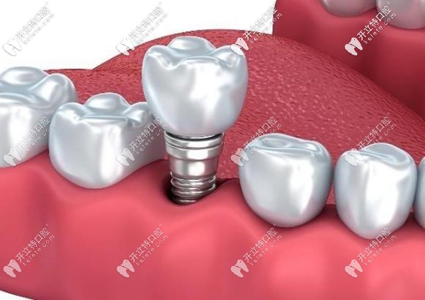 諾貝爾PMC種植體價格親民