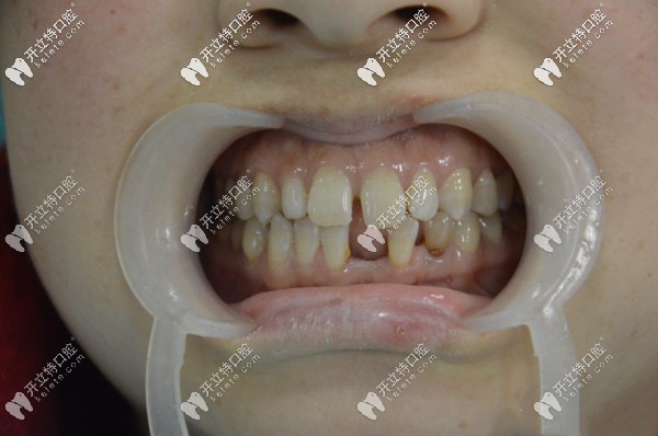 這是她門牙做6顆愛爾創(chuàng)全瓷牙修復前后的對比照片哦