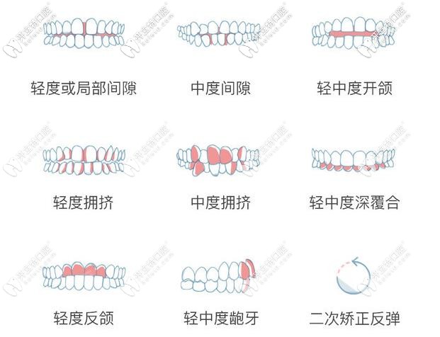 瑞速齊隱形牙套——適應(yīng)癥范圍