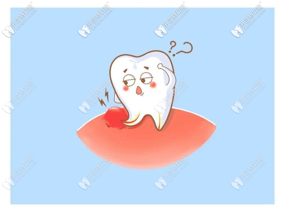 烤瓷牙上面根尖囊腫怎么辦?話說(shuō)根管治療能消除囊腫嗎