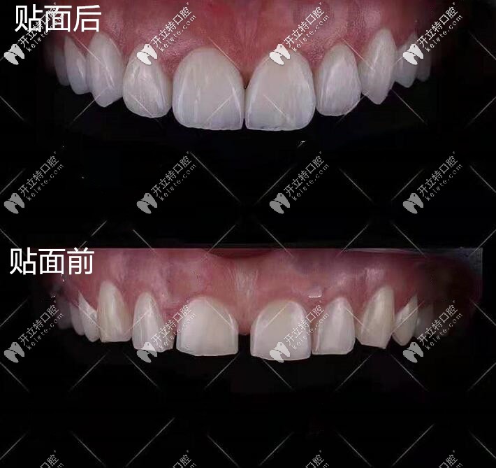 朋友剛做的超薄瓷貼面效果對(duì)比