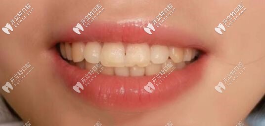 樹(shù)脂貼面近30年效果圖