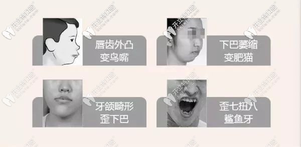 兒童牙齒早期干預(yù)適應(yīng)癥 兒童牙齒早期干預(yù)適應(yīng)癥