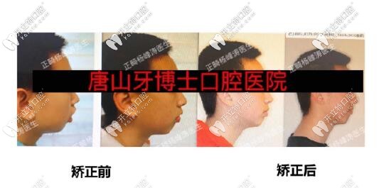 楊峰濤醫(yī)生正畸案例
