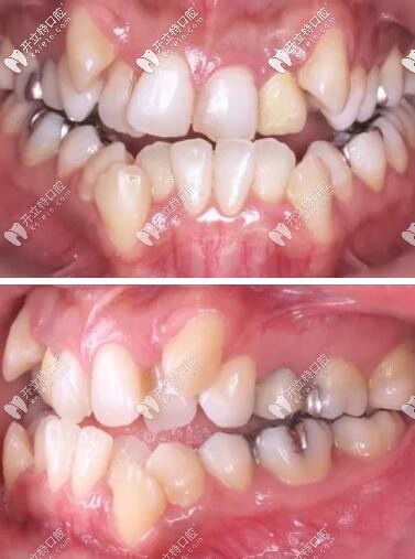 骨性三類反頜隱適美掩飾性正畸