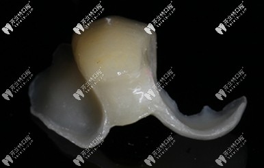 可用于牙周病造成的牙列缺損情況