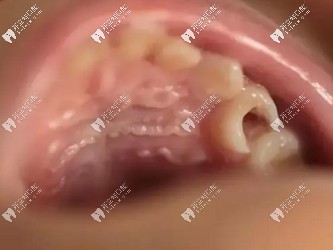 重度牙齒齲壞會(huì)導(dǎo)致補(bǔ)牙材料脫落