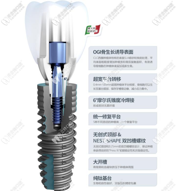 西傲（clc）種植牙優(yōu)勢介紹