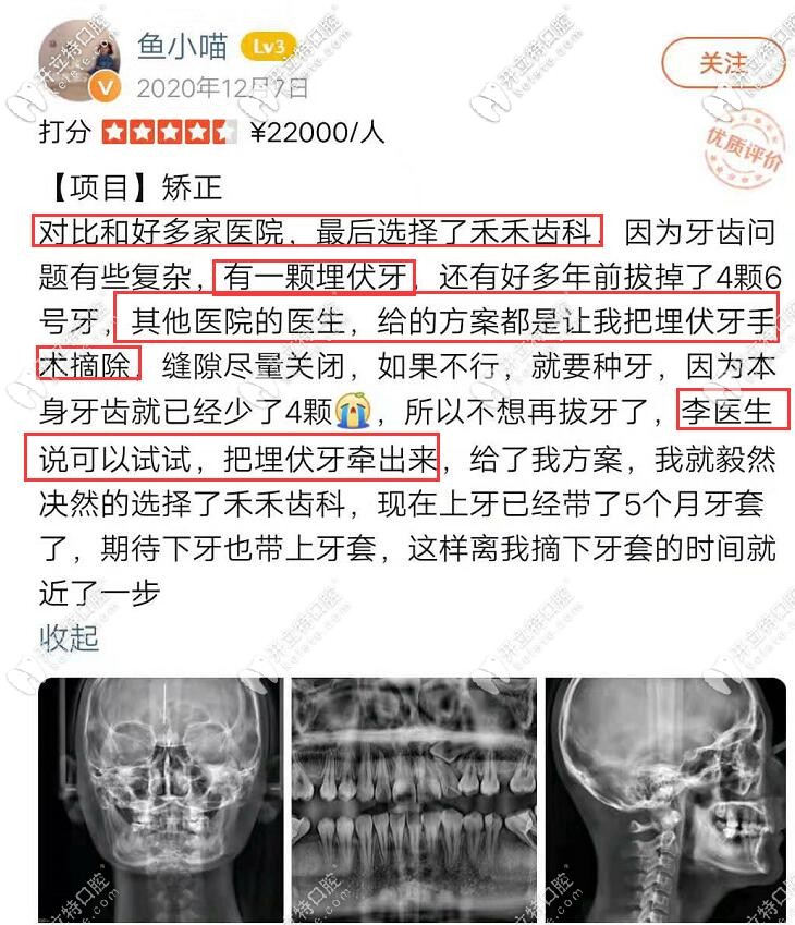 埋伏牙顧客在禾禾齒科的正畸體驗