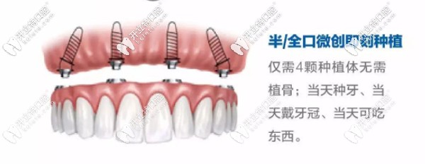 即刻種植牙優(yōu)勢(shì)