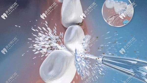 參照洗牙的分類等級表來自測你的牙齒需要做幾級洗護