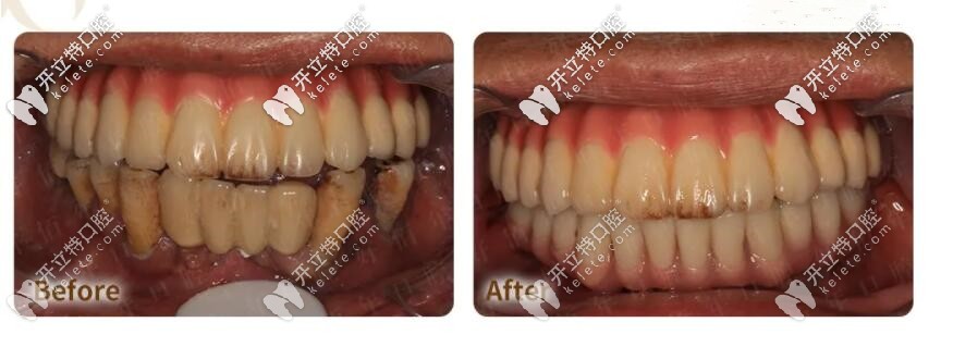 即刻負重的種植牙