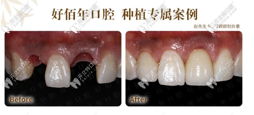 前牙即刻負重種植牙案例