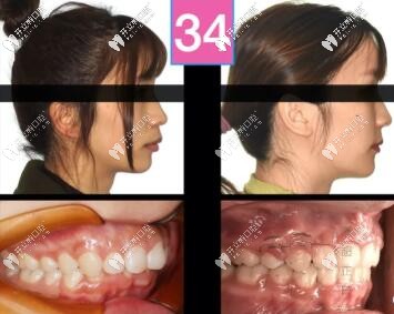 骨性二類凸嘴單純正畸牙齒內(nèi)收3-4mm側(cè)貌效果圖