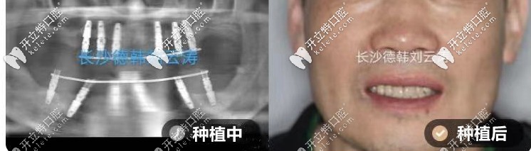 劉云濤：上半口all-on-6種植、下半口all-on-4種植