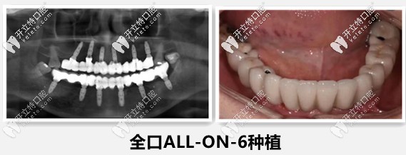 長沙德韓劉云濤醫(yī)生——全口all-on-6種植牙