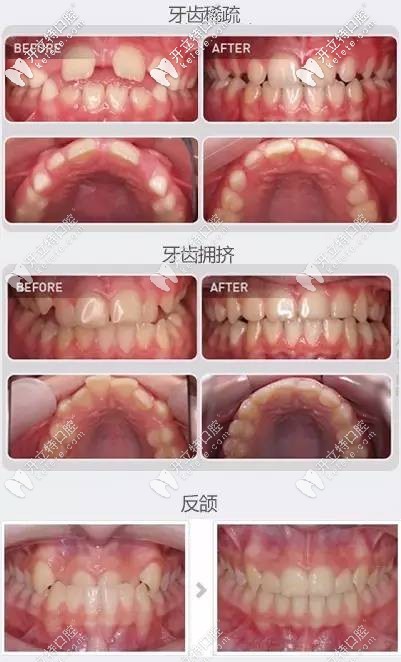熊醫(yī)生-兒童早期牙齒矯正案例（牙齒不齊、反頜等癥狀）