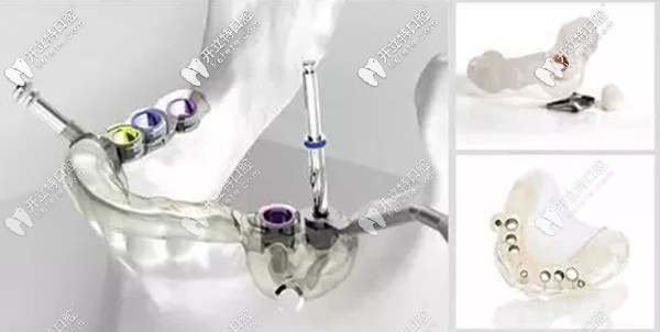 重慶牙博士口腔5-10分種一顆牙