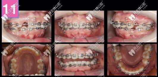 齙牙深復(fù)合牙齒矯正案例