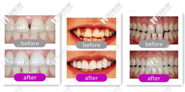 安普口腔的正畸案例