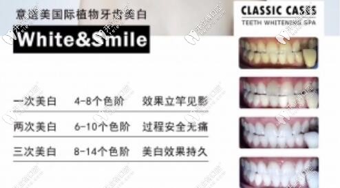 深圳正夫口腔植物牙齒美白優(yōu)勢