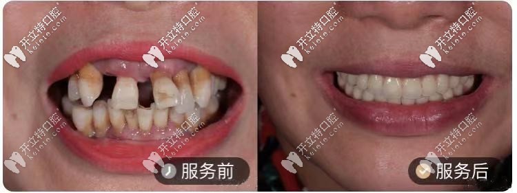 50歲阿姨，做的ALL-ON-4種植牙對比圖