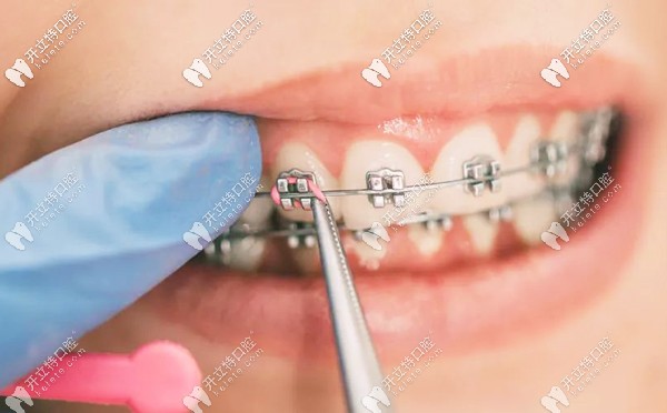 簡述日本lh魔線絲矯正和mbt直絲弓矯正的區(qū)別和效果
