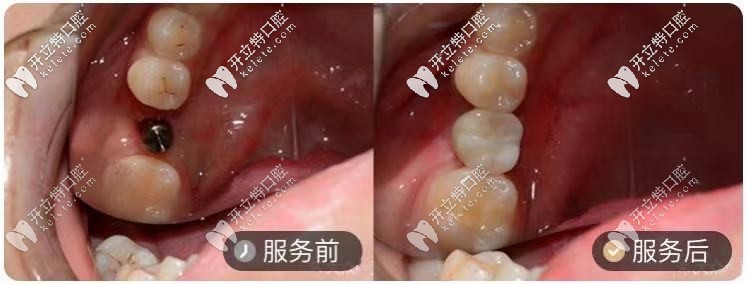在長沙牙祖口腔做的1顆韓系種植牙對比圖