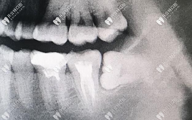 分享在杭州雅樂(lè)口腔天都城店的拔智齒過(guò)程,看我都經(jīng)歷了啥