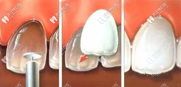 做一口全瓷貼面大概得多少錢，打算去做16顆超薄牙貼面