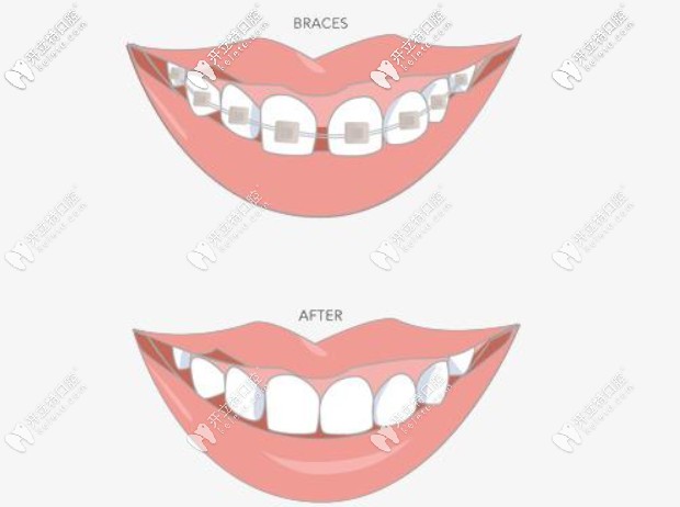 收縫前后對(duì)比