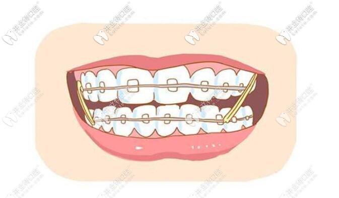 牙齒矯正的價(jià)格