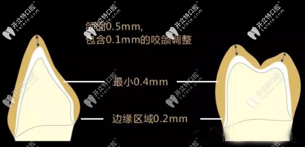 德國進口材料的格萊美全瓷牙價格