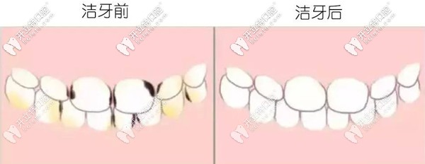 洗牙后為什么會(huì)酸痛