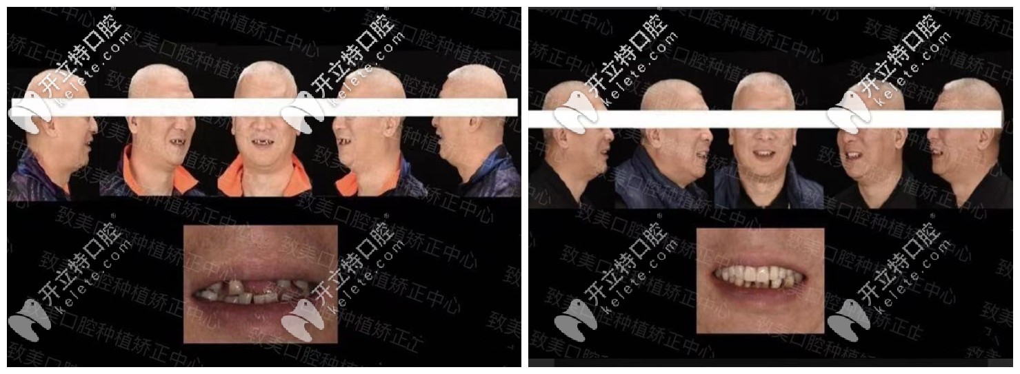 詹醫(yī)生的即刻負(fù)重種植牙案例