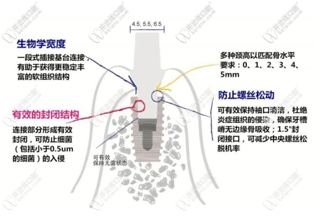 仕諾康植體特點介紹